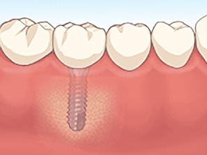 インプラント